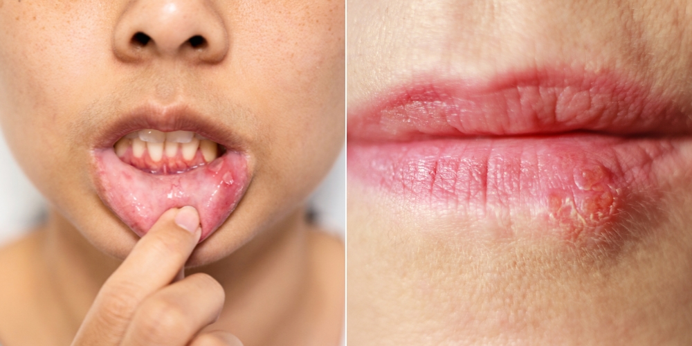 Canker Sore or Cold Sore? How to Tell the Difference and Treat Them Fast